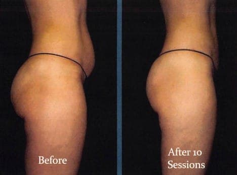 Hip and buttock area, side view, before and after body contouring