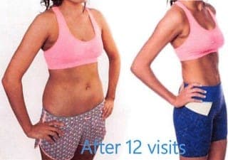 Abdomen and waist, front view, before and after body contouring