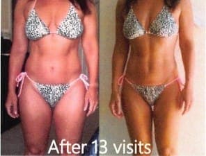 Abdomen and waist, front view in swimwear, before and after body contouring
