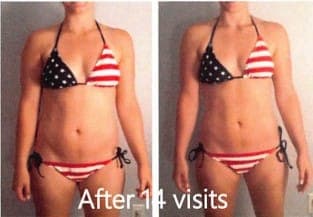 Abdomen and waist, front view in swimwear, before and after body contouring