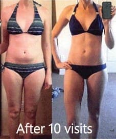 Torso, front view in swimwear, before and after body contouring