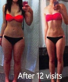 Torso, front view in swimwear, before and after body contouring