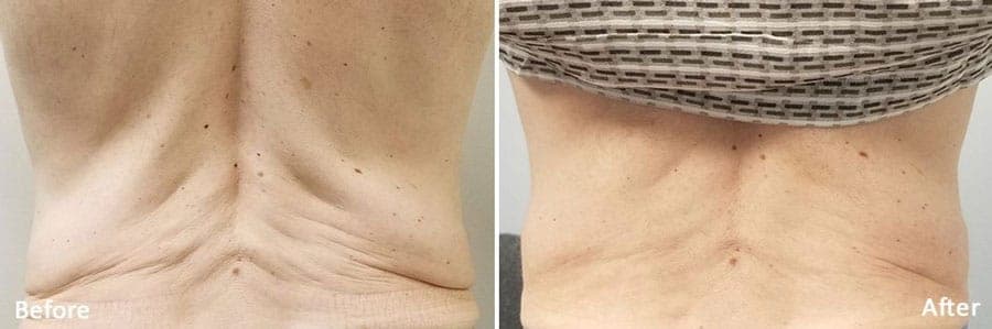Lower back skin, back view, before and after Morpheus8