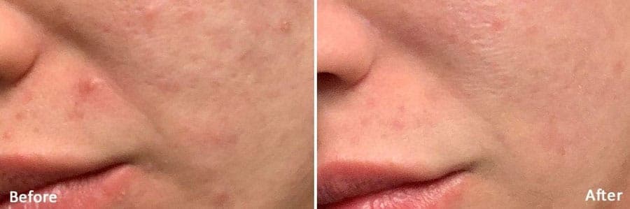 Close-up of the cheek near the nose and mouth, before and after Morpheus8