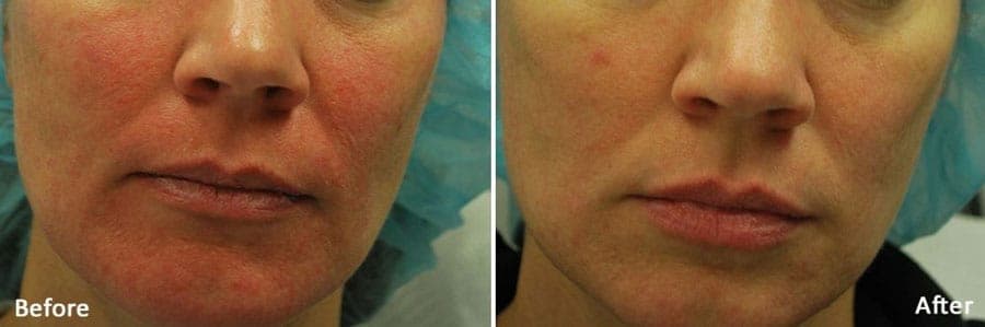 Face, front view, before and after Morpheus8