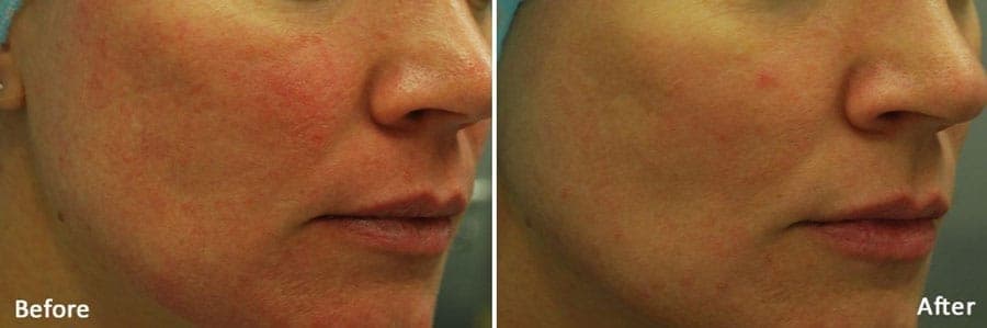 Face, angled view, before and after Morpheus8